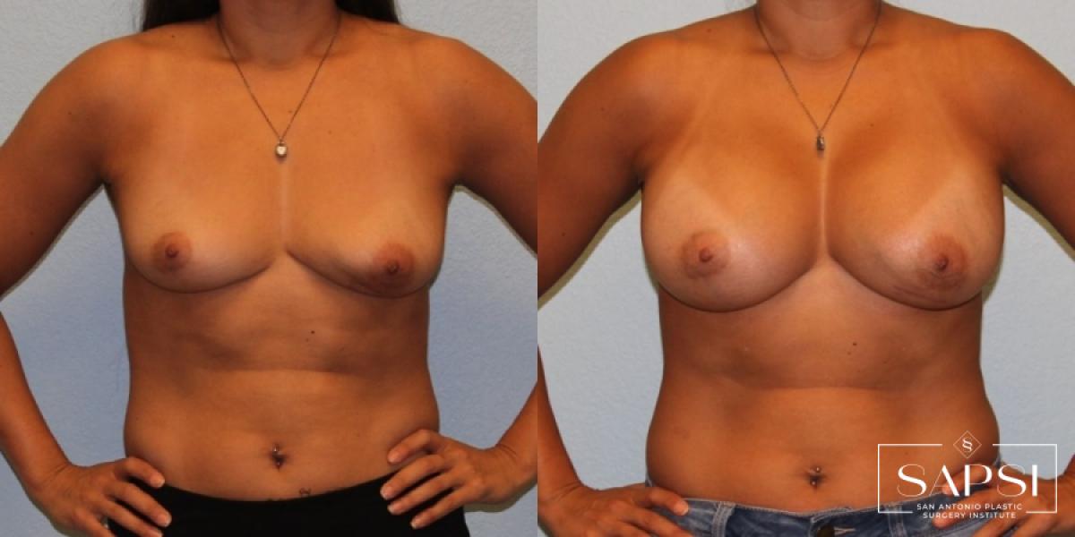 Breast Augmentation: Patient 47 - Before and After 1