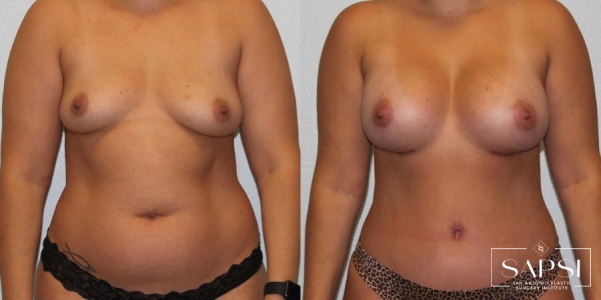 Breast Augmentation: Patient 75 - Before and After 1