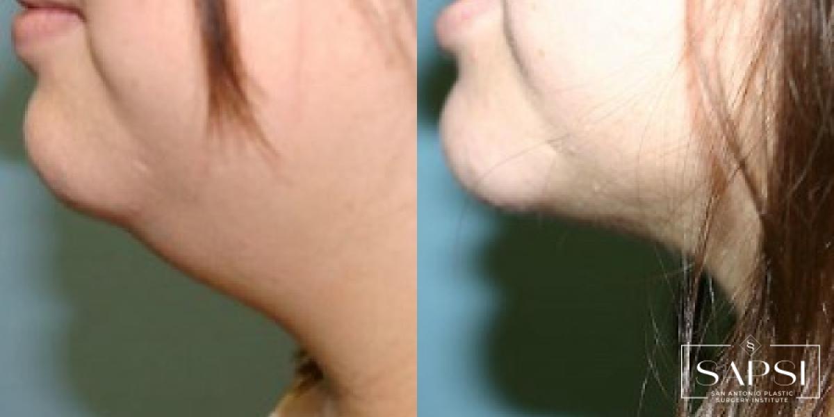 Liposuction: Patient 6 - Before and After 2