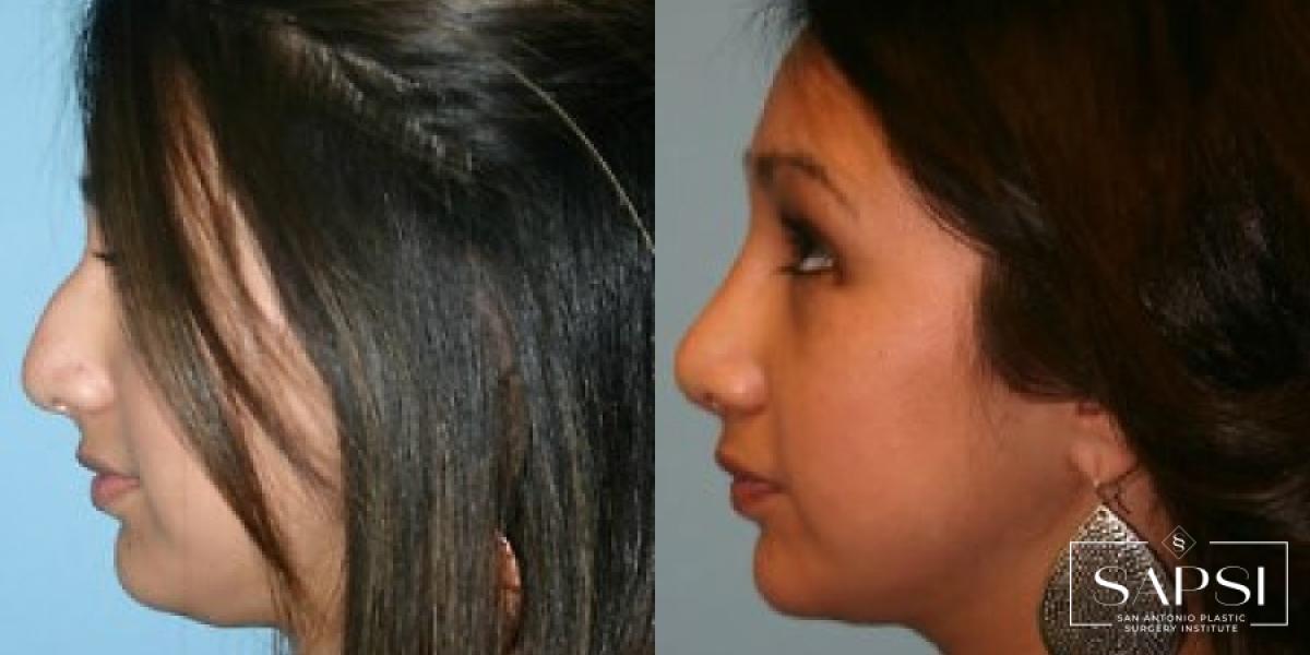 Facelift: Patient 3 - Before and After  