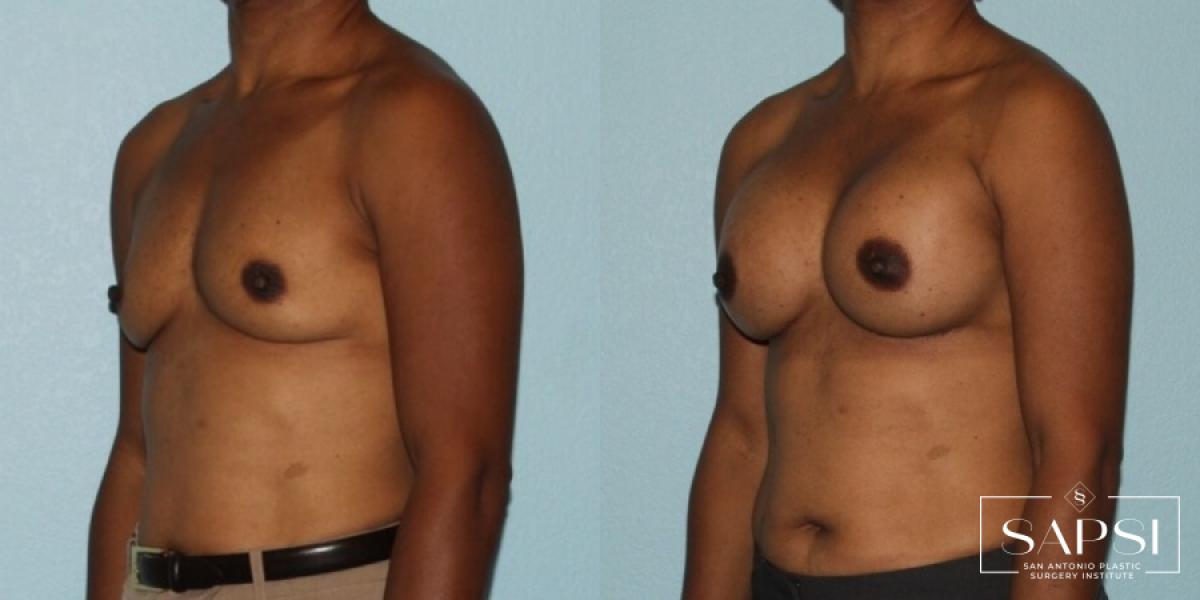 Breast Augmentation: Patient 13 - Before and After 2