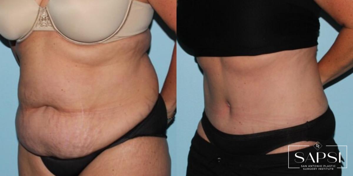 Tummy Tuck: Patient 30 - Before and After 2