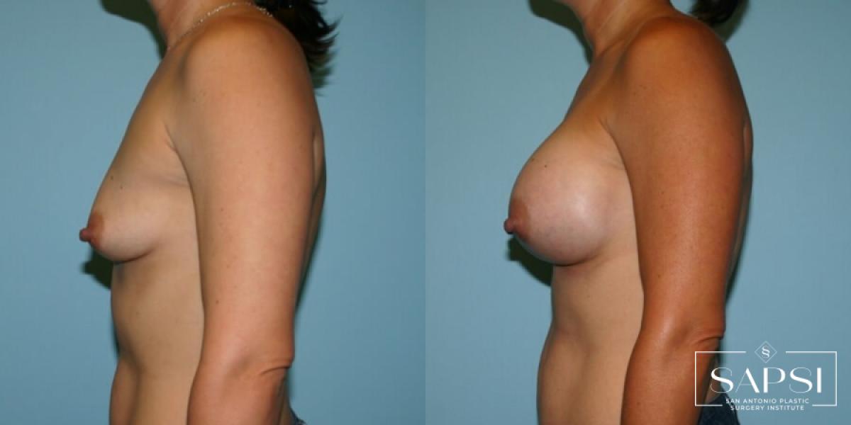 Breast Augmentation: Patient 5 - Before and After 3