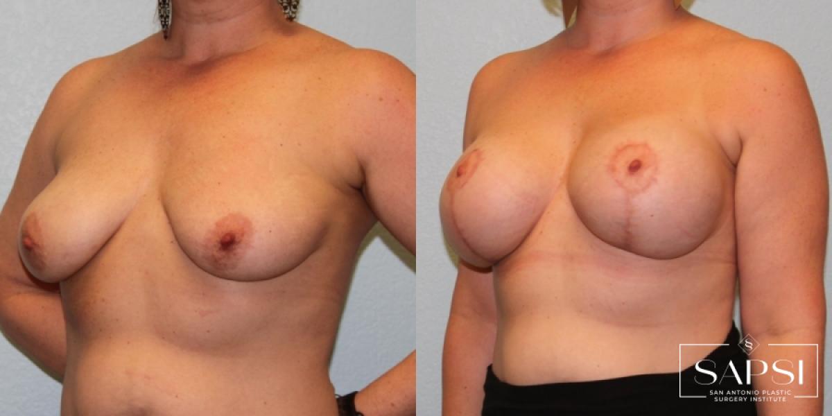 Breast Augmentation With Lift: Patient 3 - Before and After 2