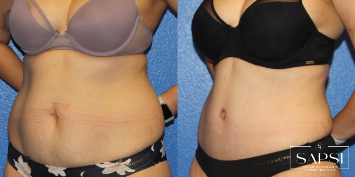 Tummy Tuck: Patient 14 - Before and After 2