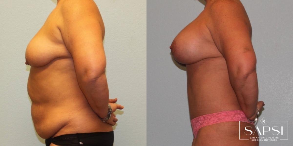 Breast Augmentation With Lift: Patient 12 - Before and After 3