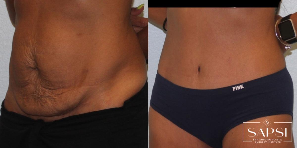 Tummy Tuck: Patient 21 - Before and After 2