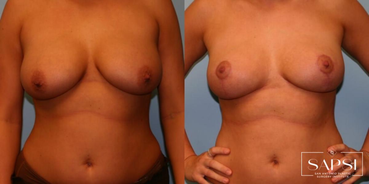 Breast Lift: Patient 13 - Before and After 1