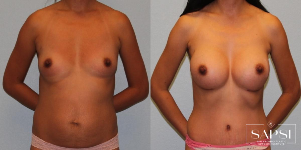 Tummy Tuck: Patient 45 - Before and After 1