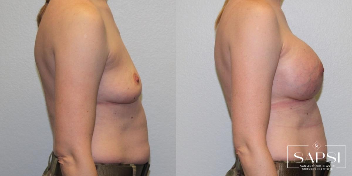 Breast Augmentation: Patient 31 - Before and After 3