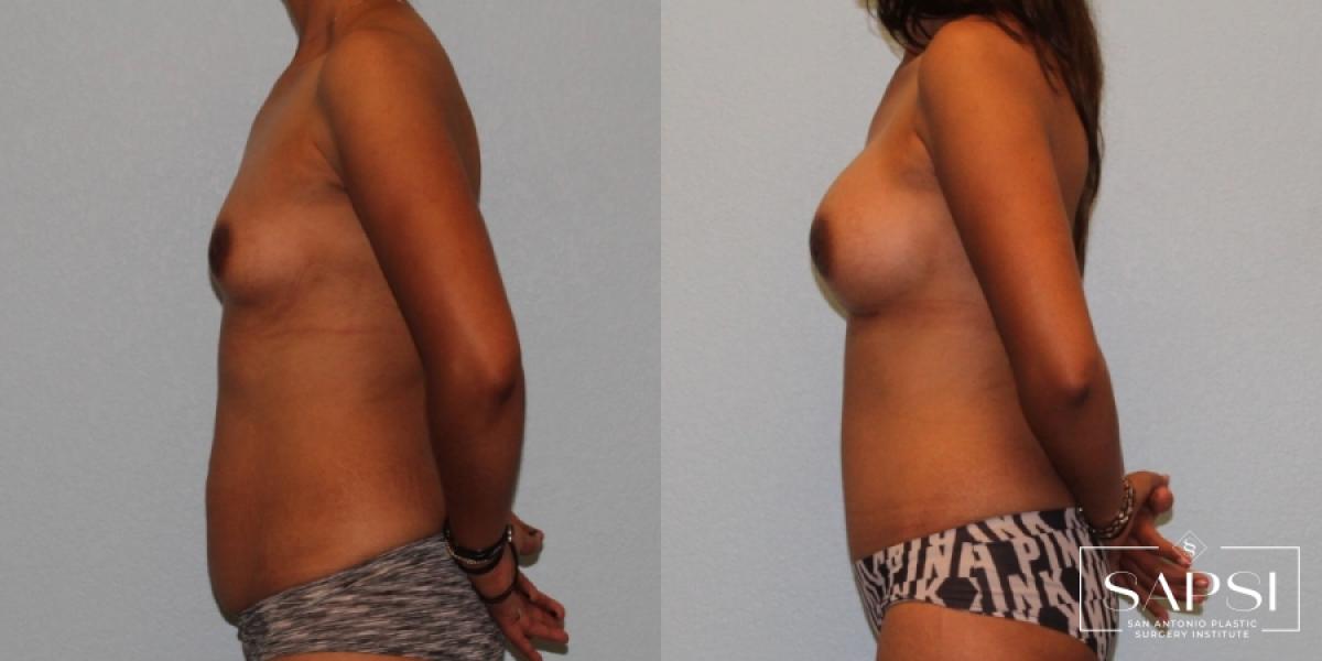 Breast Augmentation: Patient 72 - Before and After 3