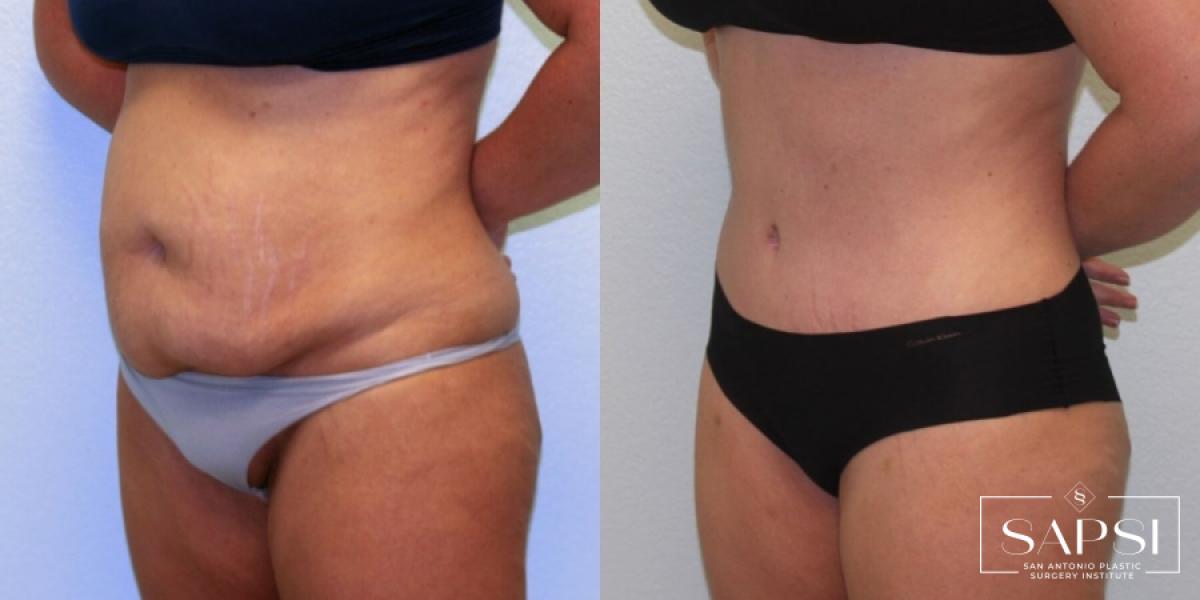 Tummy Tuck: Patient 9 - Before and After 2