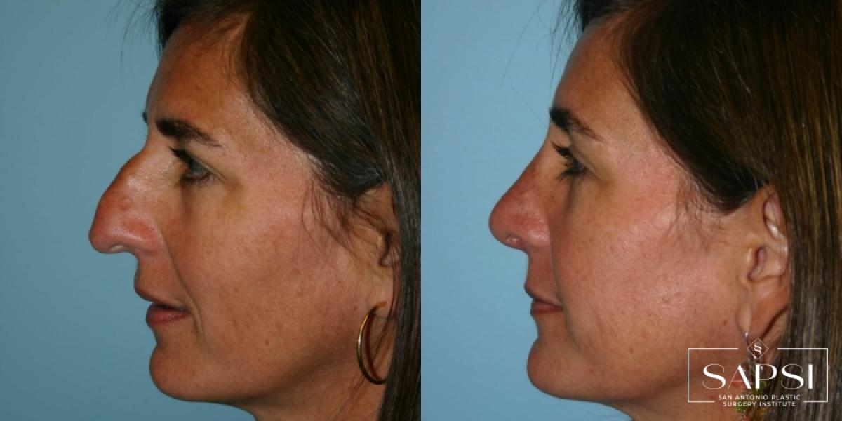 Rhinoplasty: Patient 1 - Before and After  