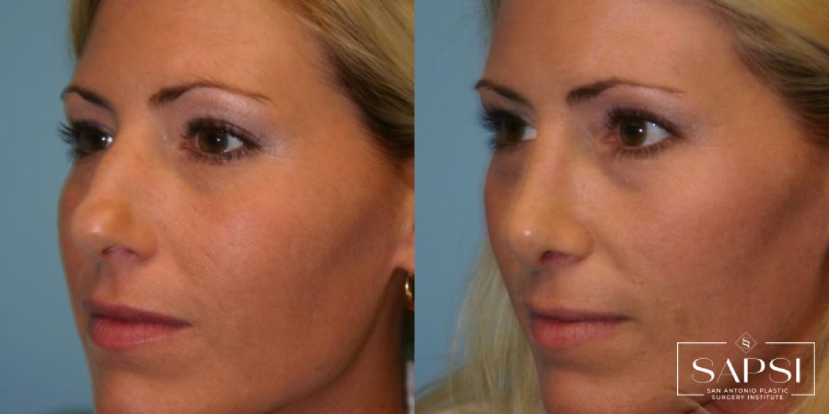 Facelift: Patient 4 - Before and After 3