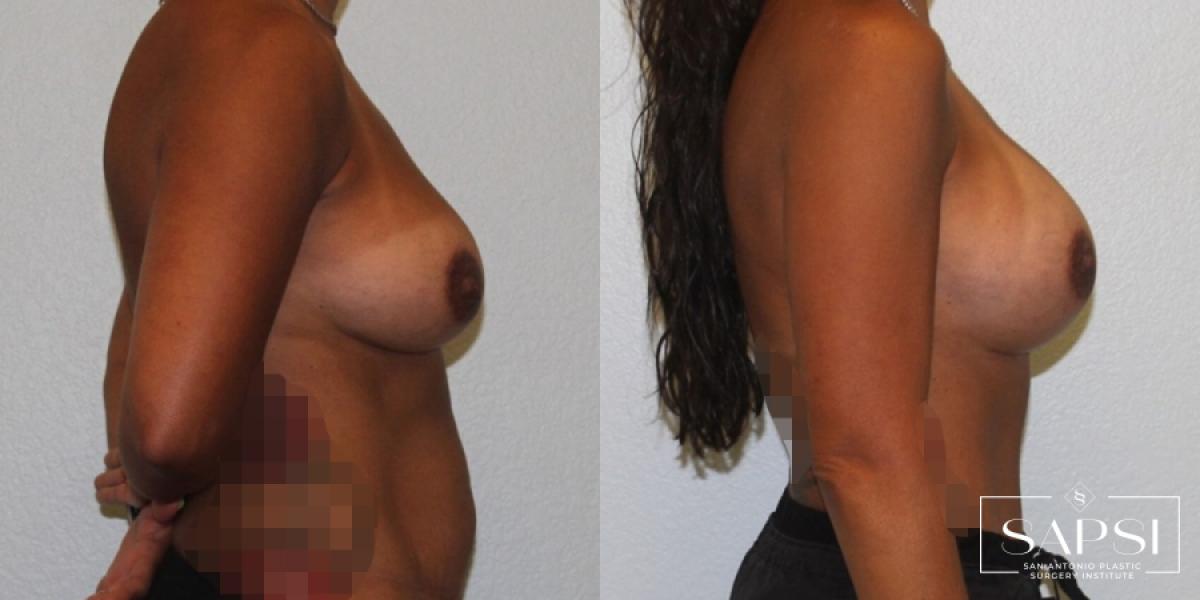 Breast Revision: Patient 4 - Before and After 3