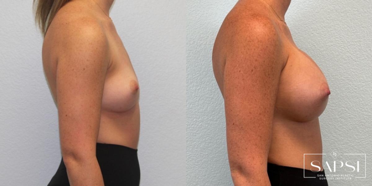 Breast Augmentation: Patient 49 - Before and After 3