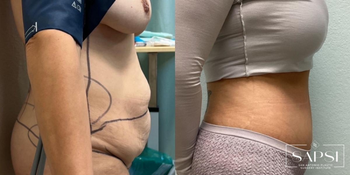 Tummy Tuck: Patient 5 - Before and After 3