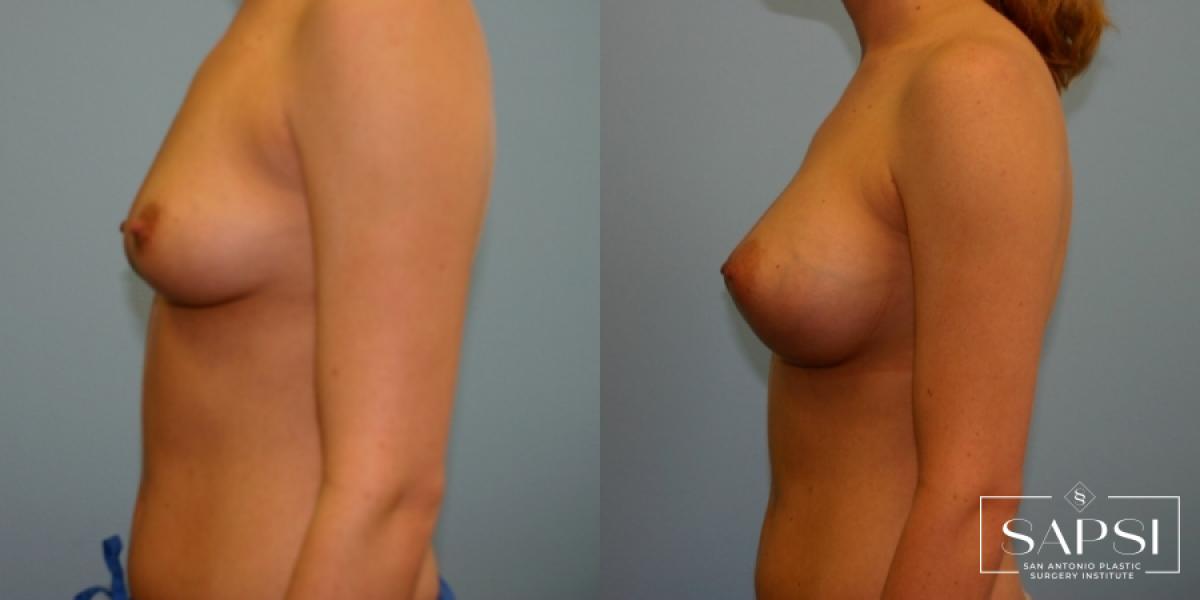 Breast Augmentation: Patient 12 - Before and After 3