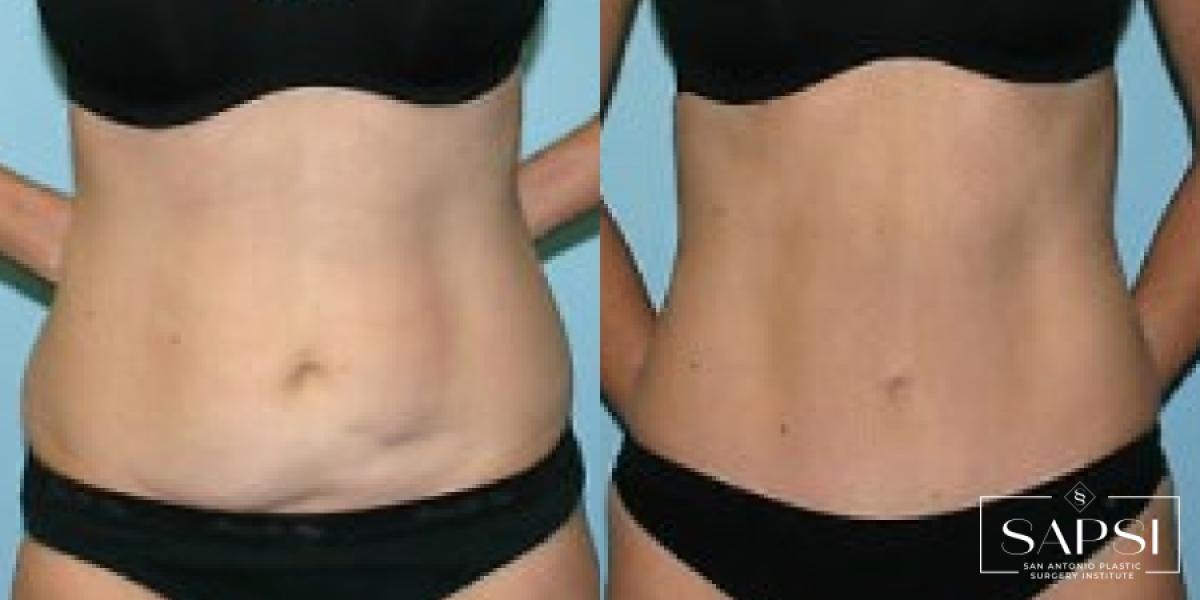 Tummy Tuck: Patient 31 - Before and After 1