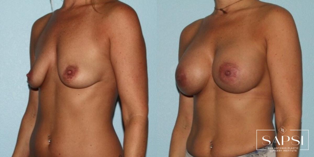 Breast Augmentation: Patient 15 - Before and After 2