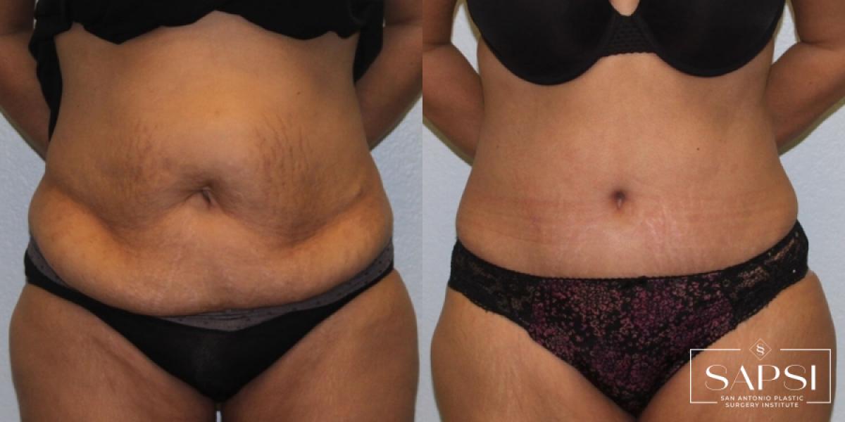 Tummy Tuck: Patient 24 - Before and After 1