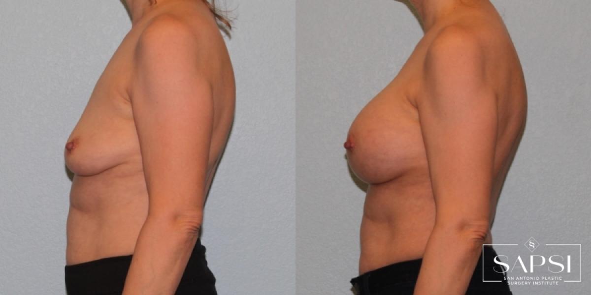 Breast Augmentation: Patient 14 - Before and After 3