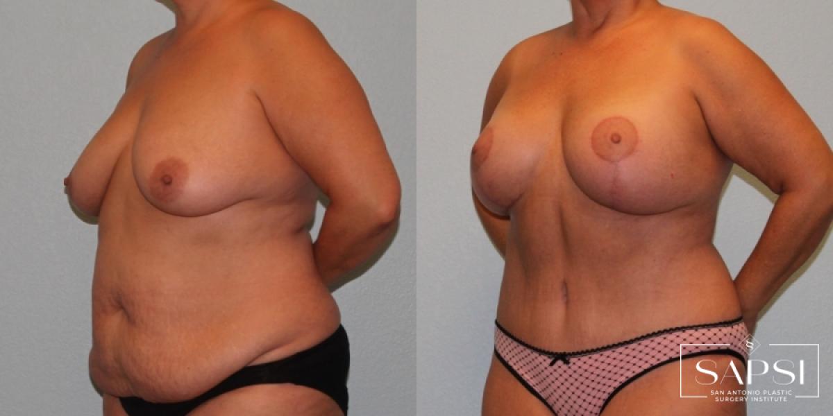 Breast Augmentation With Lift: Patient 14 - Before and After 2