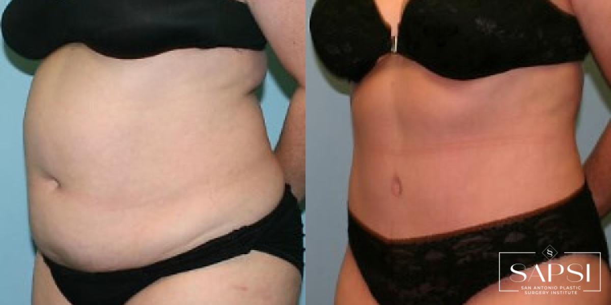 Tummy Tuck: Patient 42 - Before and After 2