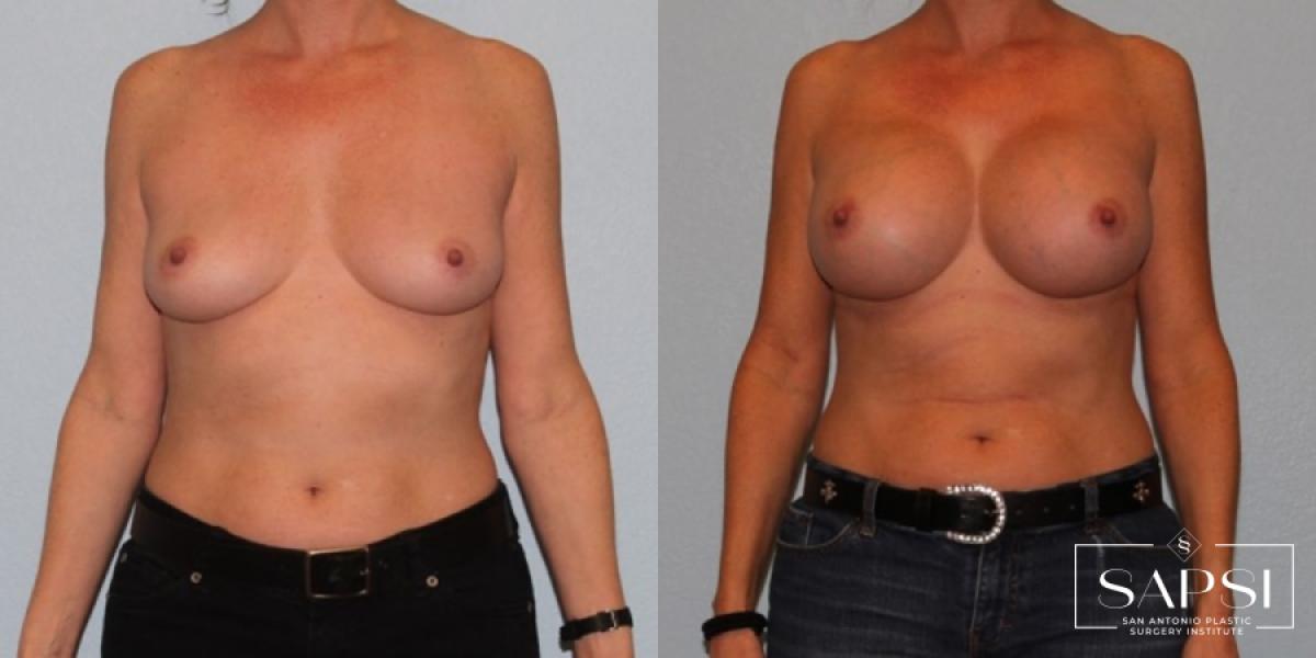 Breast Augmentation: Patient 39 - Before and After 