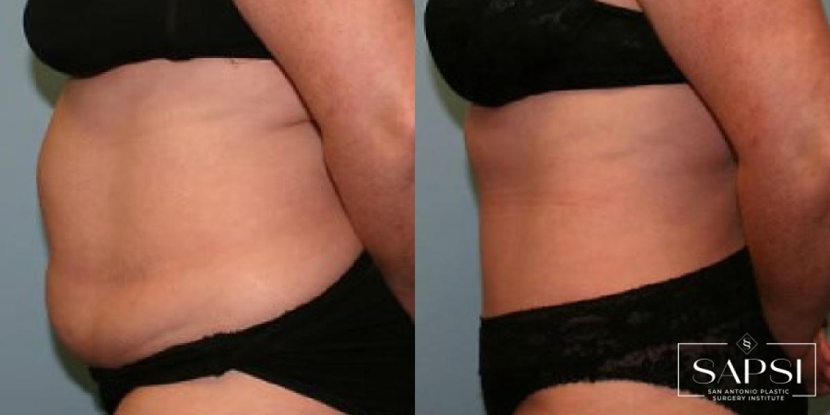 Tummy Tuck: Patient 42 - Before and After 3