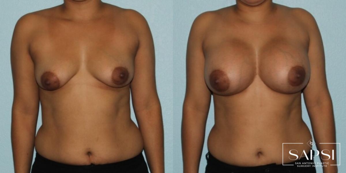 Breast Augmentation: Patient 33 - Before and After 1