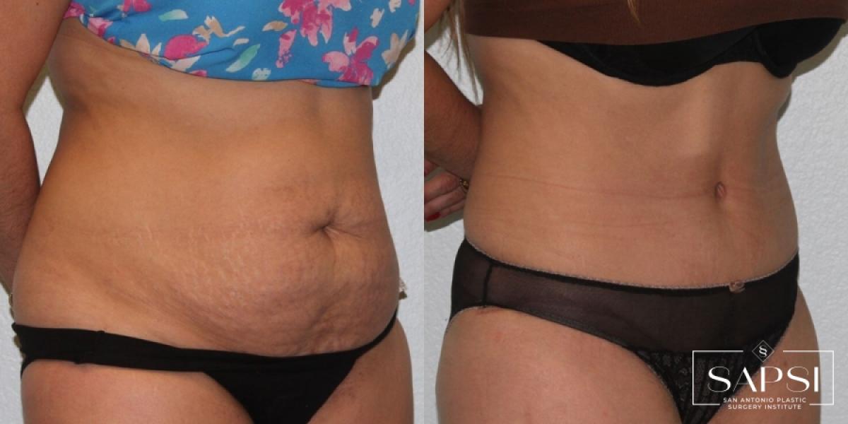 Liposuction: Patient 13 - Before and After 2