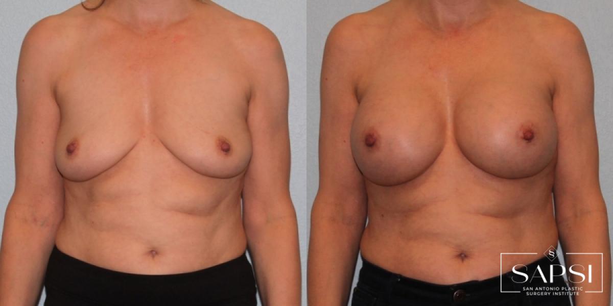 Breast Augmentation: Patient 14 - Before and After 1