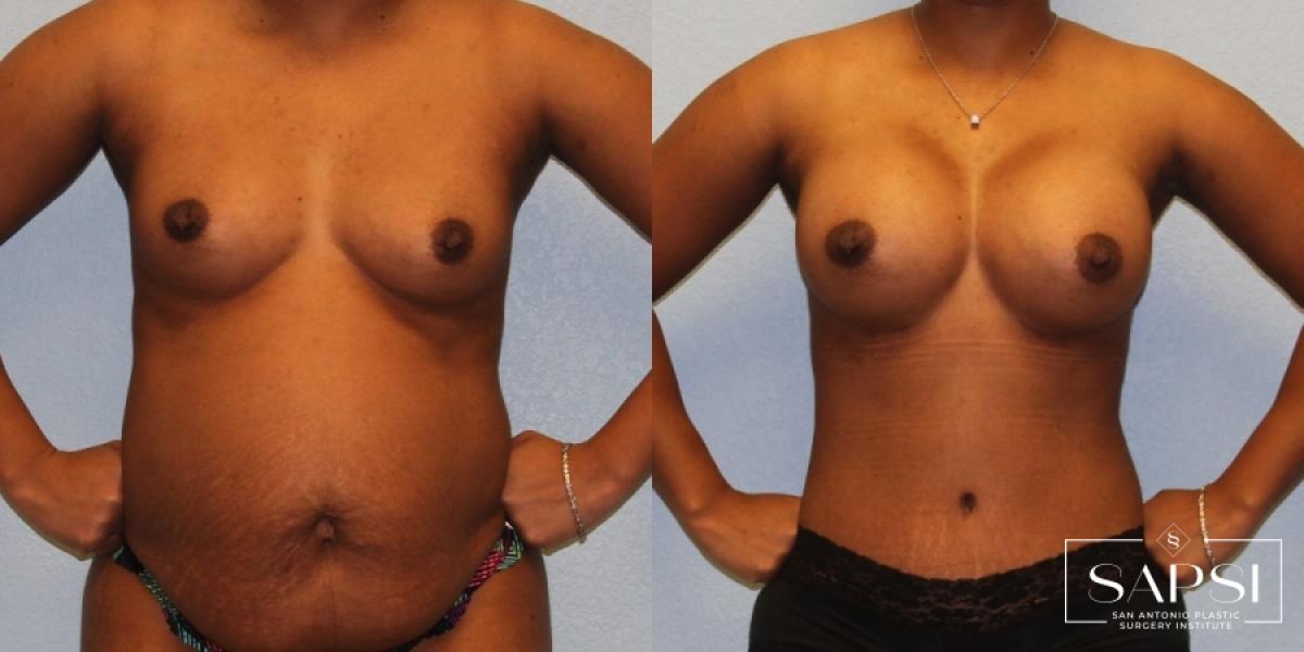 Tummy Tuck: Patient 35 - Before and After 1