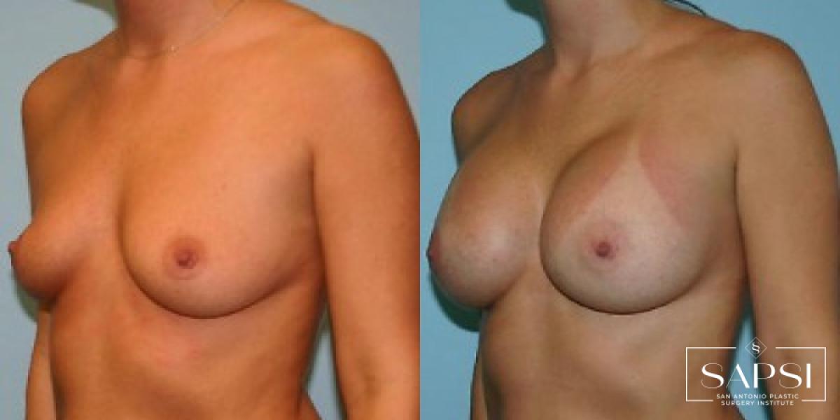 Breast Augmentation: Patient 83 - Before and After 2