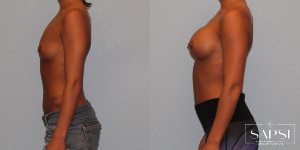 Breast Augmentation: Patient 37 - Before and After 3