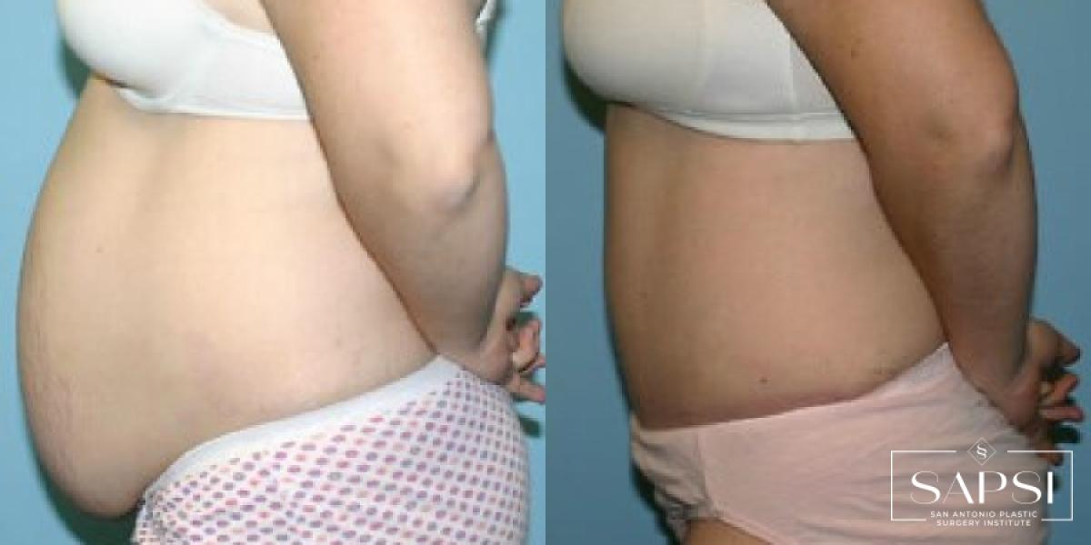 Tummy Tuck: Patient 38 - Before and After 3