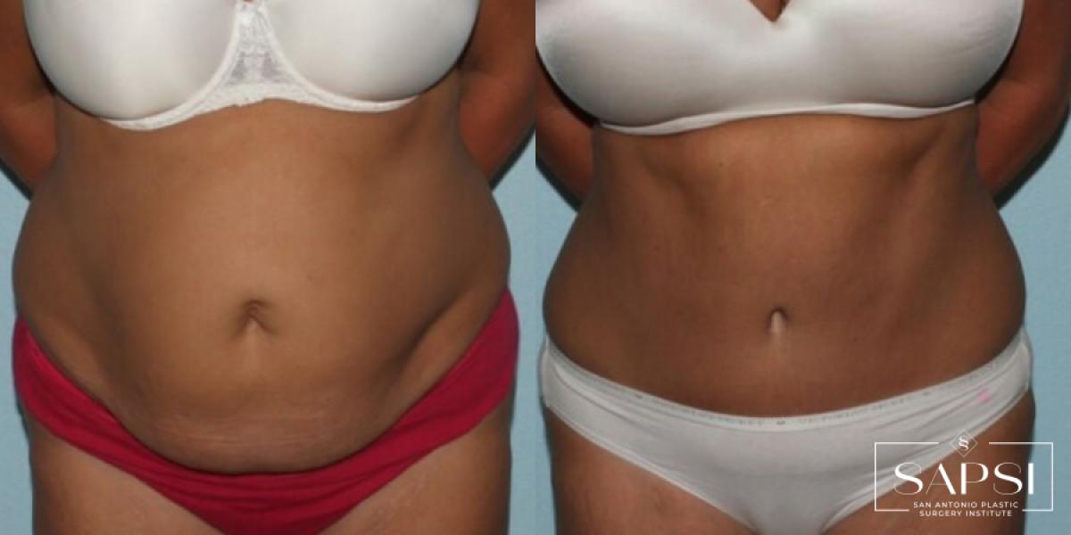 Tummy Tuck: Patient 27 - Before and After 1