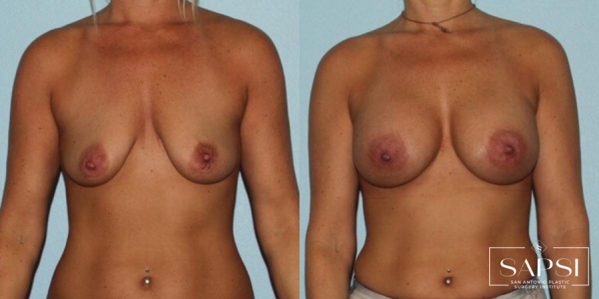 Breast Augmentation: Patient 15 - Before and After 1