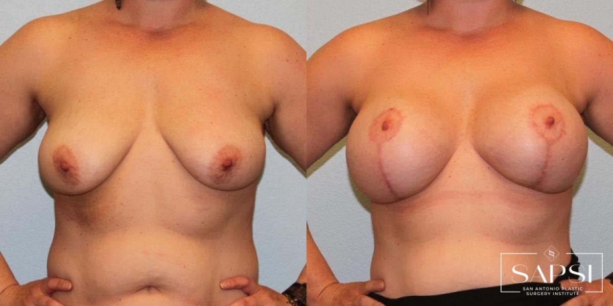 Breast Augmentation With Lift: Patient 3 - Before and After  