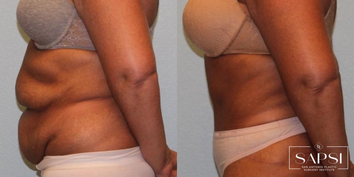 Tummy Tuck: Patient 26 - Before and After 3