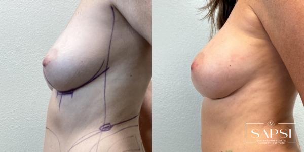 Breast Augmentation: Patient 51 - Before and After 2