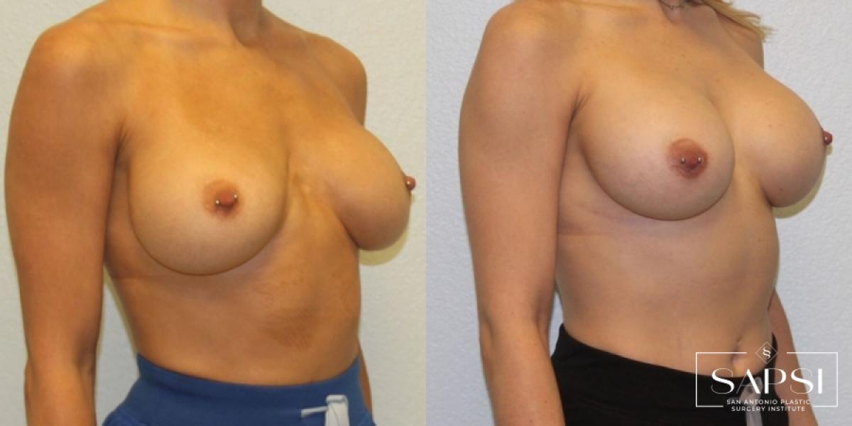 Breast Revision: Patient 1 - Before and After 2