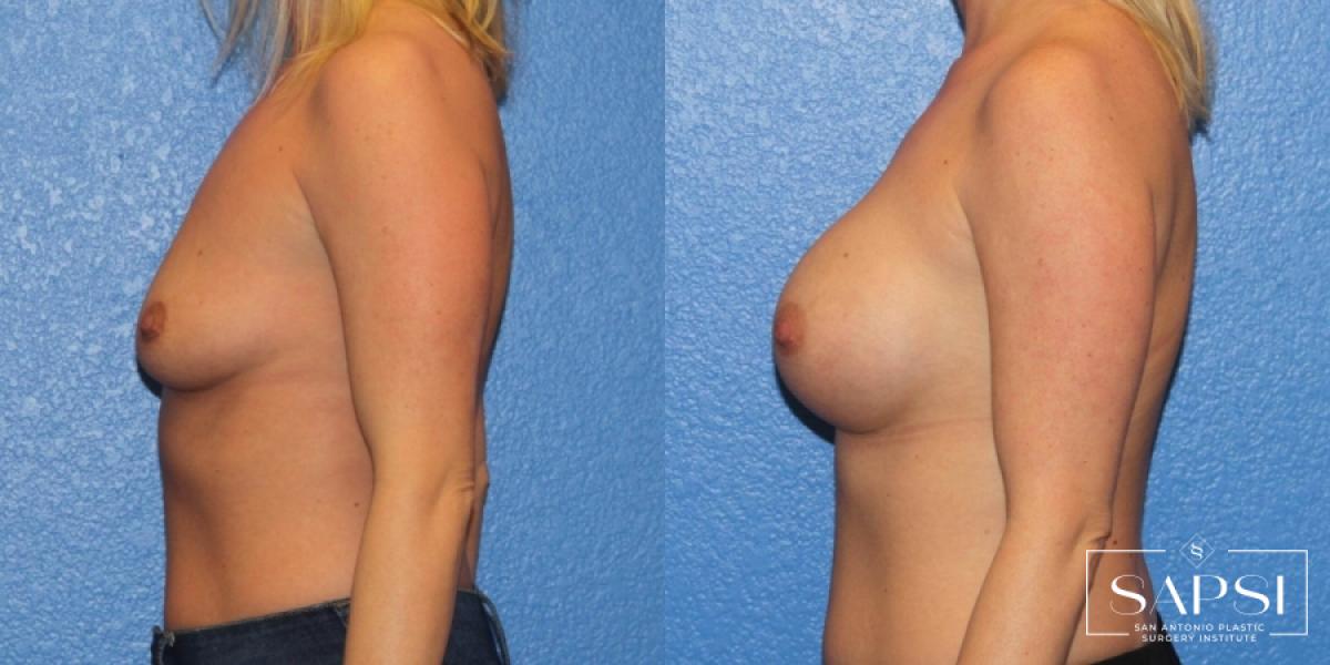 Breast Augmentation: Patient 20 - Before and After 3