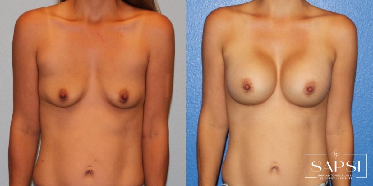 Breast Augmentation: Patient 22 - Before and After 