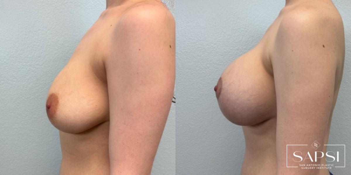 Breast Augmentation With Lift: Patient 24 - Before and After 3