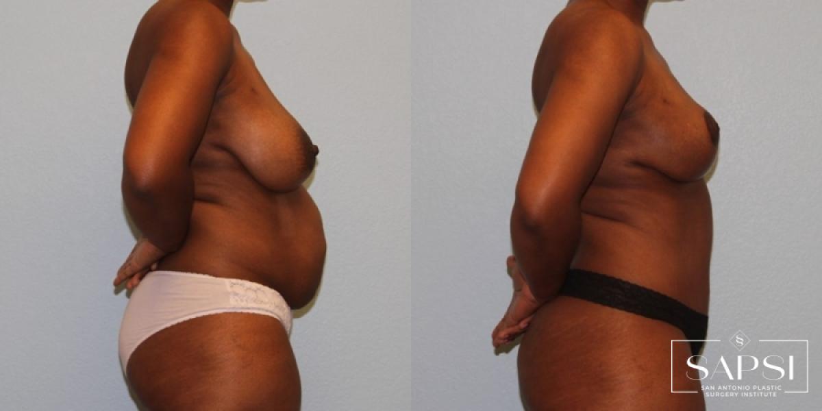 Breast Reduction: Patient 4 - Before and After 3