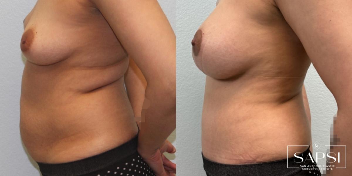 Tummy Tuck: Patient 6 - Before and After 3