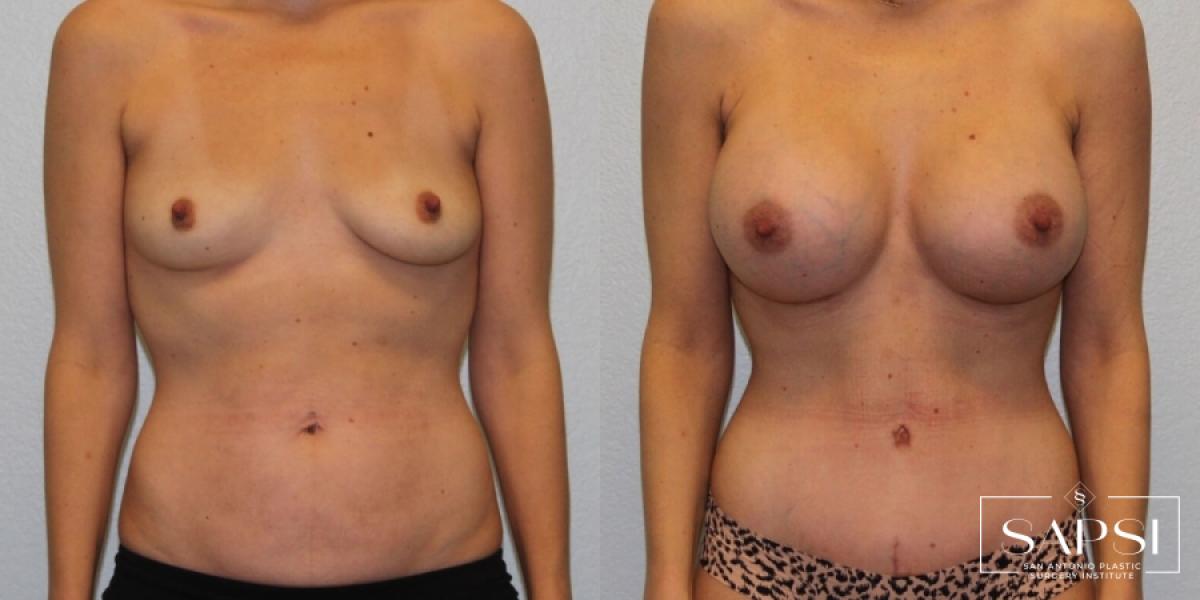 Breast Augmentation: Patient 53 - Before and After 