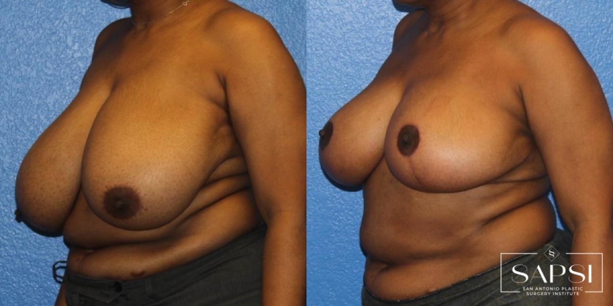 Breast Reduction: Patient 2 - Before and After 2